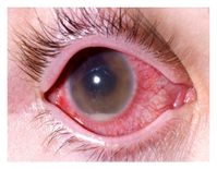 सावधान- आंखें बदले रंग हो सकता है कोरोना वायरस