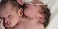 अति दुर्लभ मामला :  दो सिर, दो रीढ़ की हड्डी, तीन भुजाओं वाले बच्चे का हुआ जन्म 