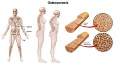 छोटे से झटके टूट जाती हड्डियां, जानिए सबसे खतरनाक बीमारी ऑस्टियोपोरोसिस के बारे में 