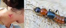 इंजीनियरिंग कॉलेज में नैरोबी मक्खियों का आतंक, सौ से अधिक छात्रों को गंभीर त्वचा संक्रमण 